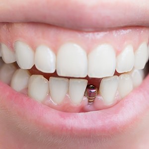Closeup of a dental implant