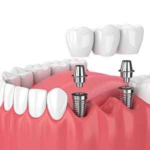 Illustration of implant bridge