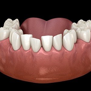 Illustration of crowded teeth