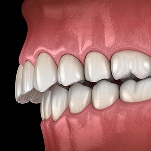 Illustration of an overbite